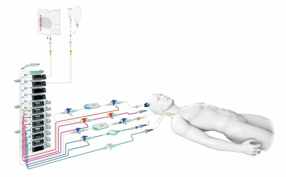 PROSET CVC LUMEN SETS-picture of article
